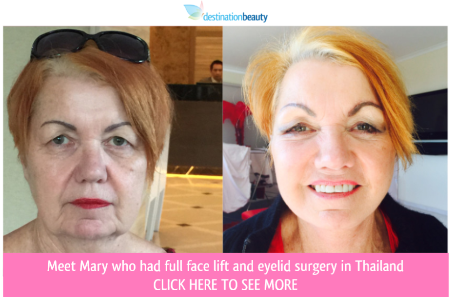 Brigid is now looking 10 years younger after face lift and eyelid surgery!